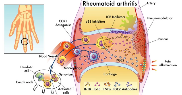 Natural Remedies for Rheumatoid Arthritis: What Works and What Doesn't